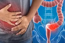 6 dấu hiệu cảnh báo nguy cơ ung thư đại tràng, cần đi khám ngay