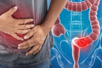 6 dấu hiệu cảnh báo nguy cơ ung thư đại tràng, cần đi khám ngay