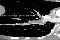 Bó lá điều trị gãy xương: Hiểm họa khó lường từ bài thuốc dân gian