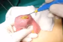 Tắc ruột do thói quen... nhai không kỹ