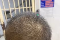 Phẫu thuật thành công cho bé trai 23 tháng tuổi bị đinh vít đâm vào đầu