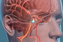 Phình mạch máu não - "Sát thủ thầm lặng tàn phá sức khỏe"