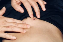 Bé trai nhập viện vì vết loét nhỏ trên da, bác sĩ cảnh báo