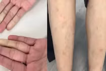 Mệt mỏi, sẩn ngứa, rụng tóc đi khám bất ngờ phát hiện... 2 bệnh tự miễn