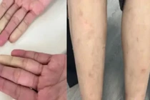Mệt mỏi, sẩn ngứa, rụng tóc đi khám bất ngờ phát hiện... 2 bệnh tự miễn