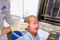Tắm lá thuốc trị vảy nến, bé trai 23 tháng tuổi trợt loét toàn thân