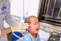 Tắm lá thuốc trị vảy nến, bé trai 23 tháng tuổi trợt loét toàn thân