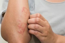 Gan bị nhiễm độc quá nhiều, cơ thể thường có 7 triệu chứng này