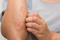 Gan bị nhiễm độc quá nhiều, cơ thể thường có 7 triệu chứng này