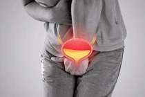 Trót đi "bóc bánh trả tiền", người đàn ông mắc bệnh kín nguy hiểm