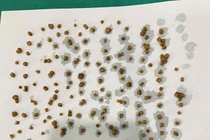 Nội soi lấy 172 viên sỏi trong túi mật người phụ nữ 46 tuổi