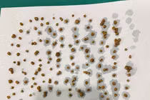 Nội soi lấy 172 viên sỏi trong túi mật người phụ nữ 46 tuổi