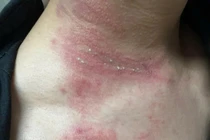 Nhiều người dính độc kiến ba khoang, xử lý tổn thương thế nào?