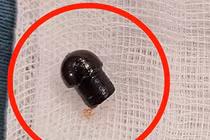 Bé trai tử vong do hóc đầu bút, sơ cứu trẻ hóc dị vật thế nào?