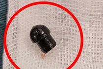 Bé trai tử vong do hóc đầu bút, sơ cứu trẻ hóc dị vật thế nào?