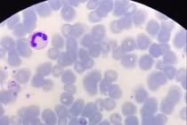 Đi rừng ở nước ngoài về, người đàn ông 31 tuổi mắc sốt rét ngoại lai