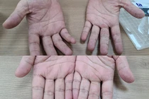 Nhiều người vào viện cầu cứu vì bệnh da mùa mưa