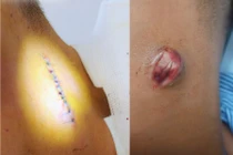 Coi thường mụn nhọt... biến chứng nguy hiểm