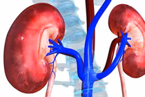 Người đàn ông 45 tuổi bị sốc nhiễm khuẩn, thận ứ mủ do... sỏi niệu quản