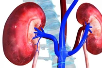 Người đàn ông 45 tuổi bị sốc nhiễm khuẩn, thận ứ mủ do... sỏi niệu quản