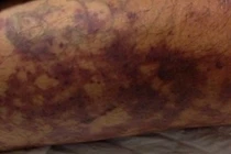 Suy đa phủ tạng sau giết mổ lợn, cách nào phòng tránh liên cầu lợn?​