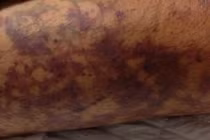 Suy đa phủ tạng sau giết mổ lợn, cách nào phòng tránh liên cầu lợn?​