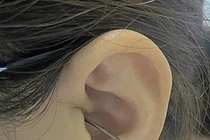 Bị người nhà va trúng khi đang lấy ráy tai, cô gái thủng màng nhĩ 