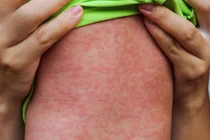 Cứu sống bệnh nhi mắc sởi biến chứng viêm cơ tim cấp