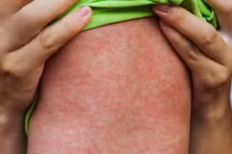 Cứu sống bệnh nhi mắc sởi biến chứng viêm cơ tim cấp