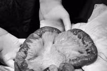 Người đàn ông 64 tuổi suýt hoại tử ruột non do thoát vị bẹn