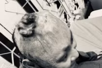 Chủ quan vết thương nhỏ trên da, người đàn ông mắc ung thư biểu mô vảy