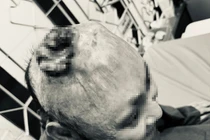 Chủ quan vết thương nhỏ trên da, người đàn ông mắc ung thư biểu mô vảy