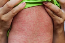 Ca mắc rubella đầu tiên trong năm 2024 ở Hà Nội đã tiêm vaccine phòng bệnh