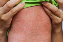 Ca mắc rubella đầu tiên trong năm 2024 ở Hà Nội đã tiêm vaccine phòng bệnh