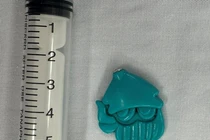 Gắp dị vật đồ chơi nằm trong thực quản bé trai 4 tuổi