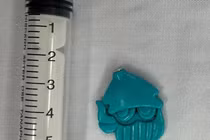 Gắp dị vật đồ chơi nằm trong thực quản bé trai 4 tuổi