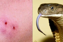 Bị rắn độc rắn, sơ cứu thế nào cho đúng?