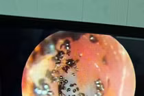 Ổ ve rận ký sinh trong tai bé gái 6 tuổi