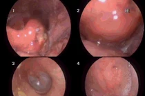 Tự lấy xương cá bị hóc, người đàn ông phù nề hạ họng, thanh quản