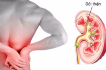 Dấu hiệu nhận biết cơn đau do sỏi thận