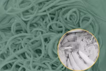 Giải phóng hơn 100 con giun trong ruột bé trai 2 tuổi