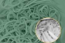 Giải phóng hơn 100 con giun trong ruột bé trai 2 tuổi