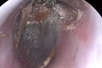 Con bướm chết trong tai người phụ nữ gây viêm, sung huyết