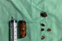 Đang dọn vườn, người đàn ông bị cành cây đâm xuyên góc hàm vào tận cổ