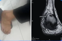 Đau gót chân uống thuốc không khỏi, đi khám phát hiện viêm xương tủy