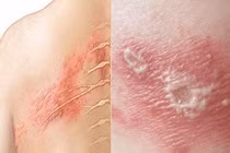 Người đàn ông 47 tuổi bị liệt mặt sau khi mắc zona thần kinh