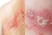 Người đàn ông 47 tuổi bị liệt mặt sau khi mắc zona thần kinh