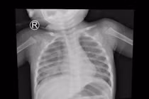 Viêm phổi vì uống dầu thắp đèn, trẻ nuốt nhầm hoá chất nguy hiểm sao?