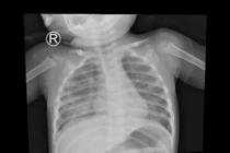 Viêm phổi vì uống dầu thắp đèn, trẻ nuốt nhầm hoá chất nguy hiểm sao?