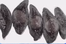 Đau bụng âm ỉ, đi khám ngỡ ngàng vì khối dị dạng hiếm gặp ở nách